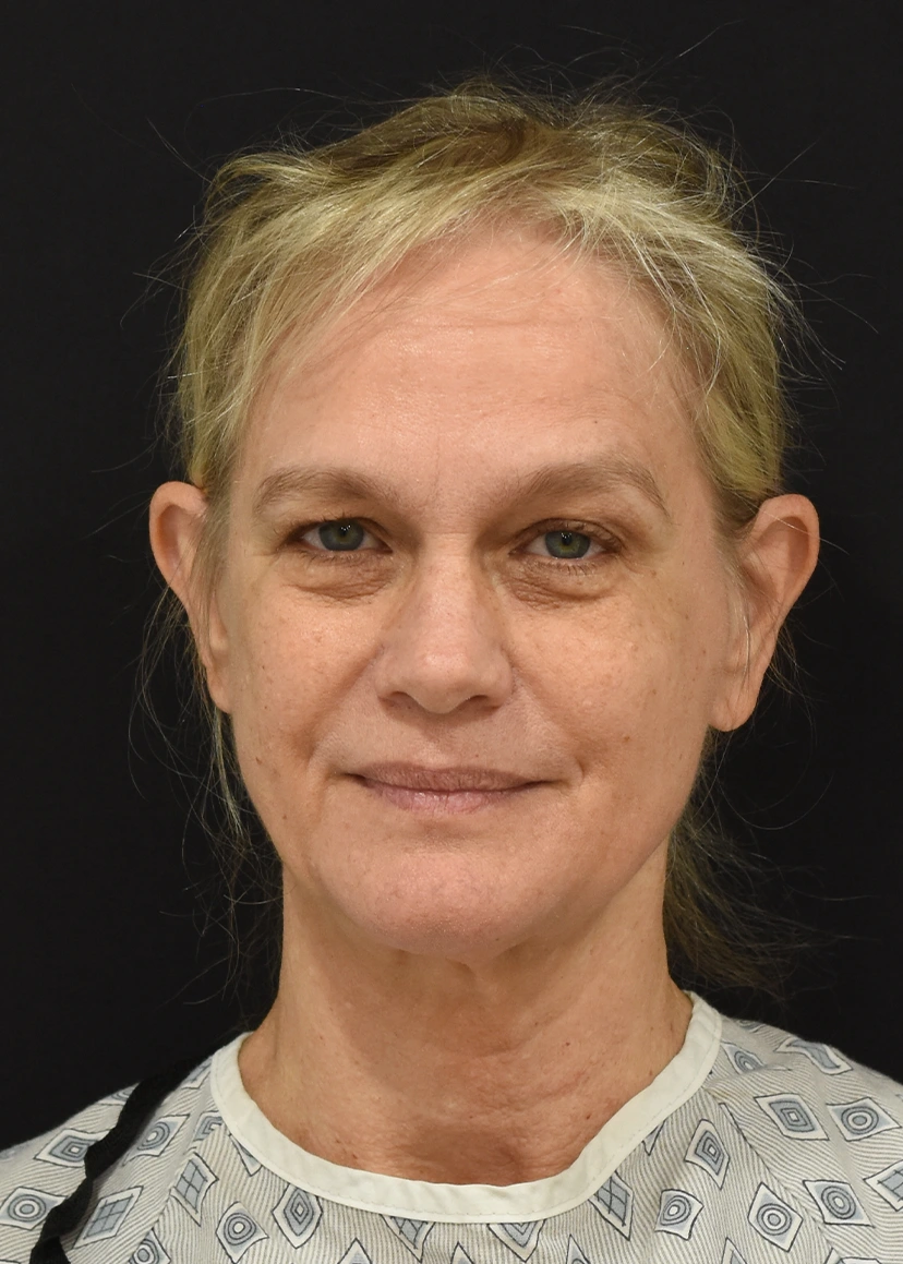 Deep Plane Facelift Patient 32 Set 1 Before